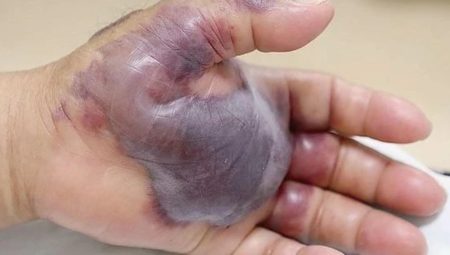 Sağlık Bakanlığı’ndan ‘vibrio bakterisi’ açıklaması